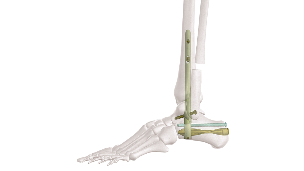  Hand & Foot Implants